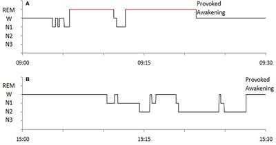 Dream Generation and Recall in Daytime NREM Sleep of Patients With Narcolepsy Type 1